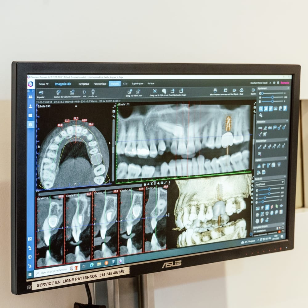 Dental Implants in La Prairie